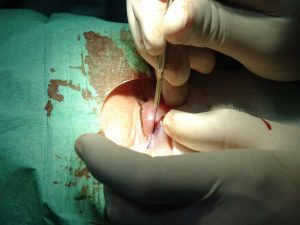 Blefaroplastia