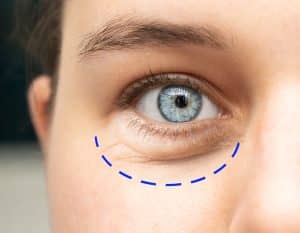blefaroplastia transconjuntival