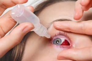 Derrame en el ojo